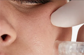 micro needling amesbury